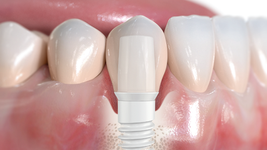 Implant stomatologiczny - Implant zębowy