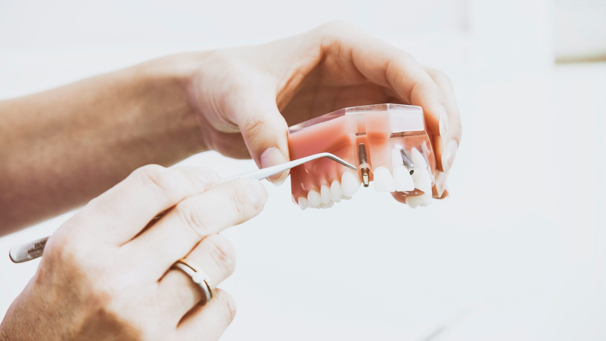 Implanty zębowe - nowoczesne rozwiązania protetyczne - Artsmile Łódź