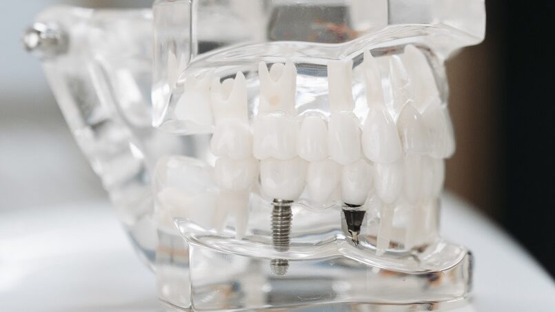 Implanty stomatologiczne - Implanty zębowe