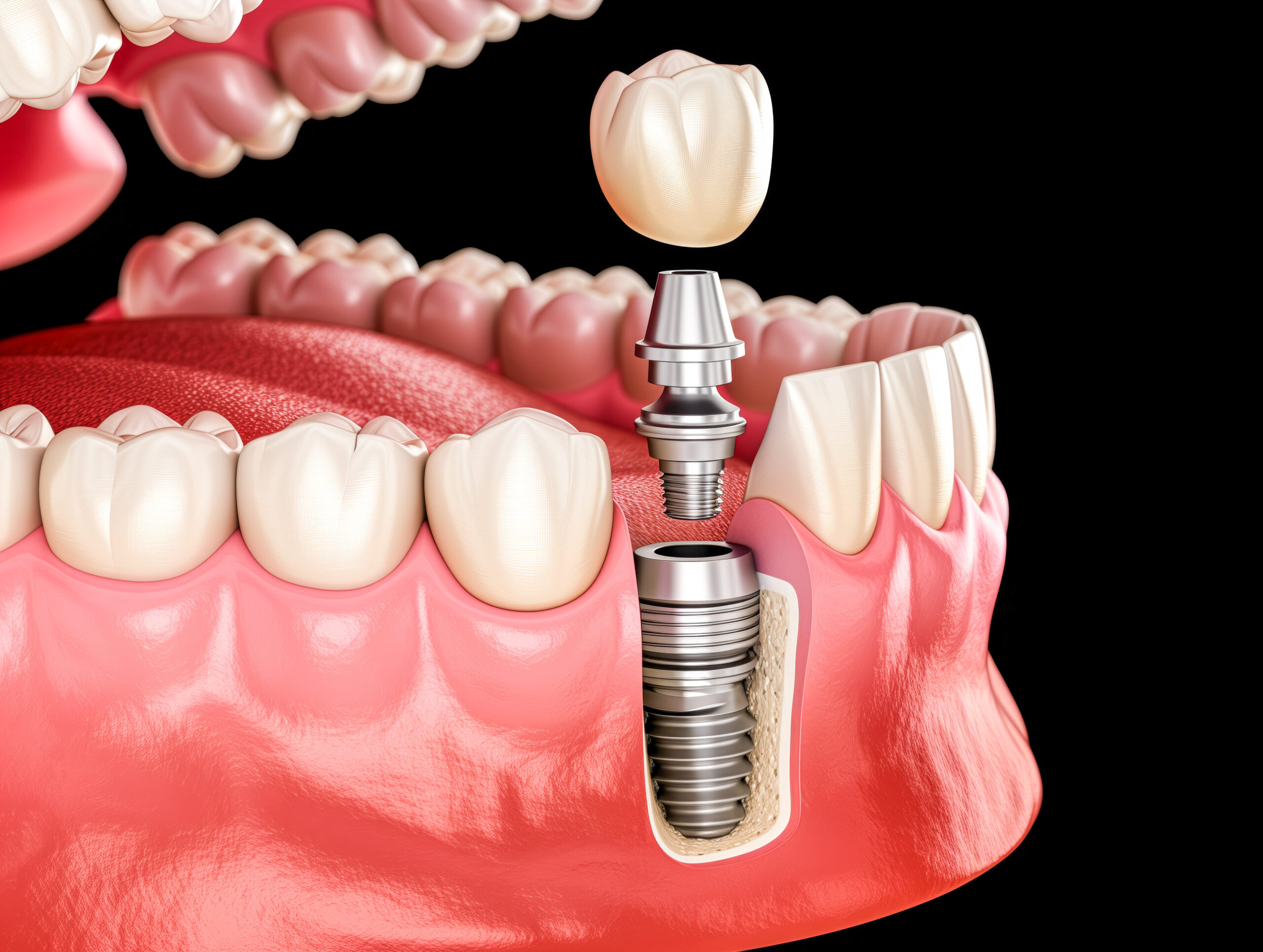 Implanty stomatologiczne